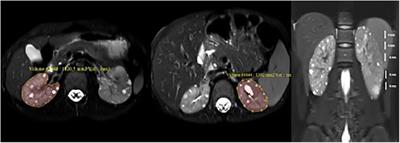 Magnetic resonance imaging based kidney volume assessment for risk stratification in pediatric autosomal dominant polycystic kidney disease